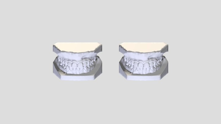 許X茿-咬合 3D Model