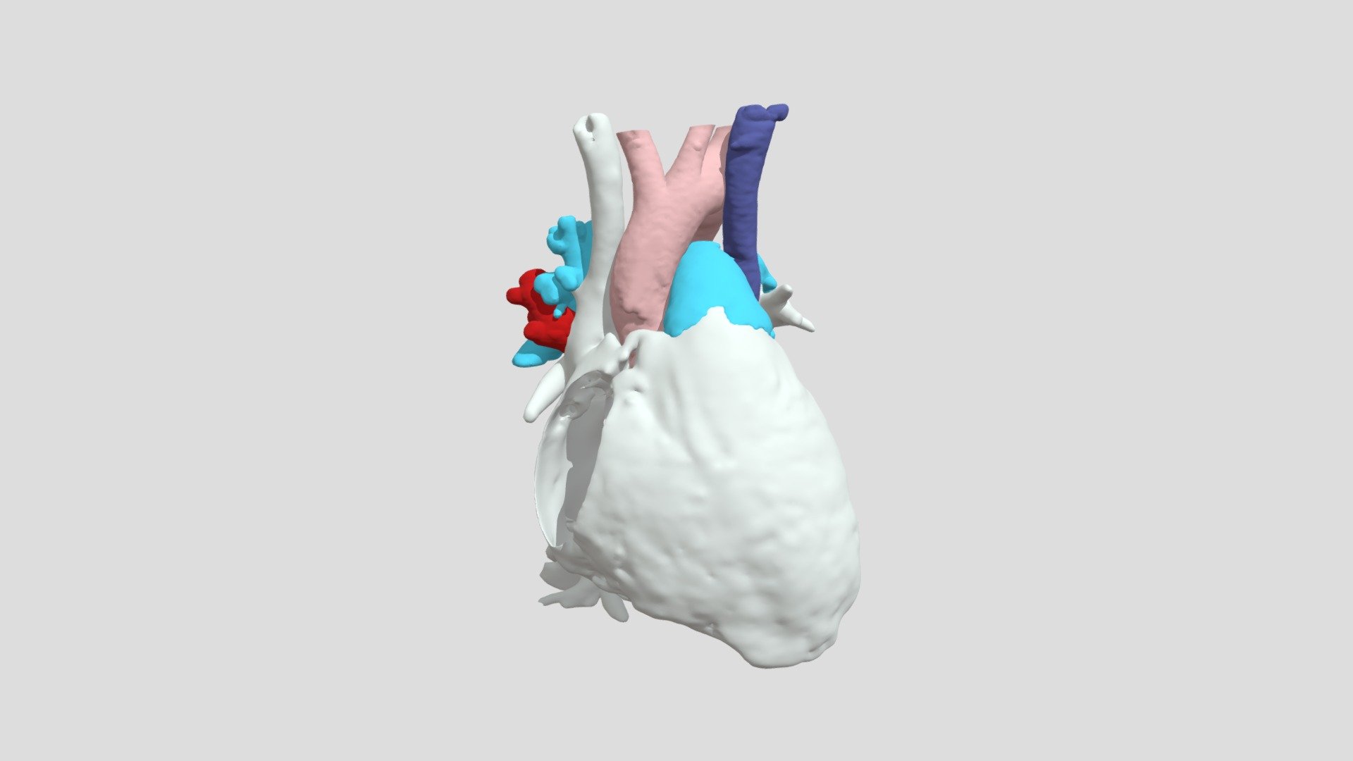 Sinus Venosus Defect, PAPVR (S0400) - 3D model by NCH Advanced Projects ...