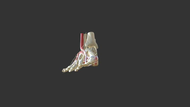 Hallux Valgus 3D Model