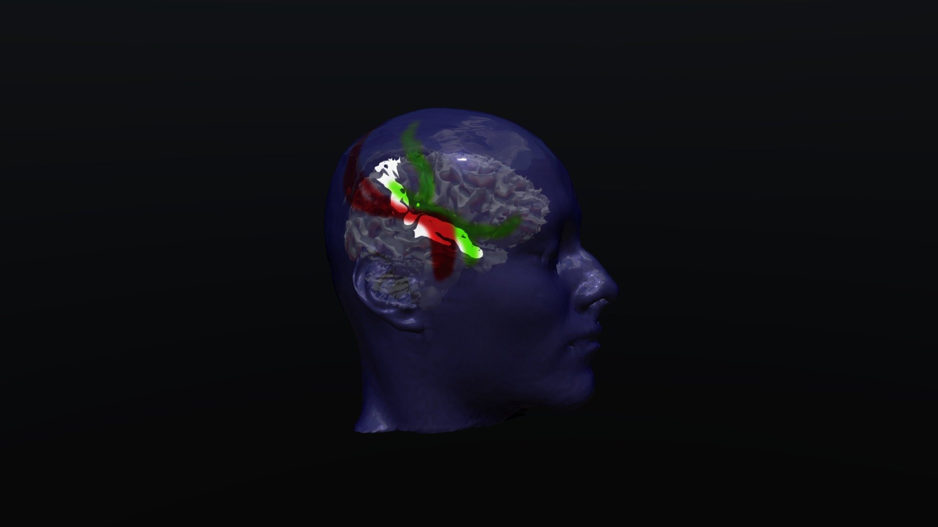 Posterior Quadrant Disconnection For Epilepsy 3d Model By Juan Arias