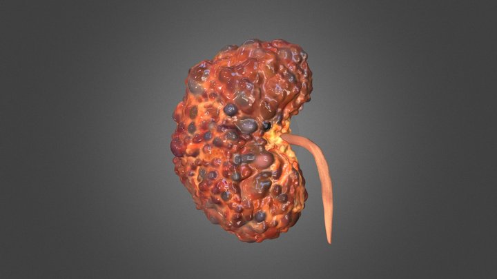 Polycystic Kidney 3D Model
