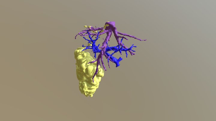 case1 SHV hepatic tumor extension 3D Model
