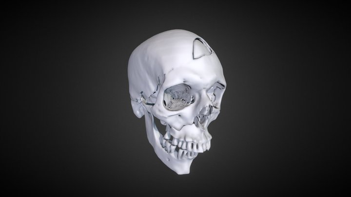 RIMASYS | CMF fractures | M-1603314 3D Model