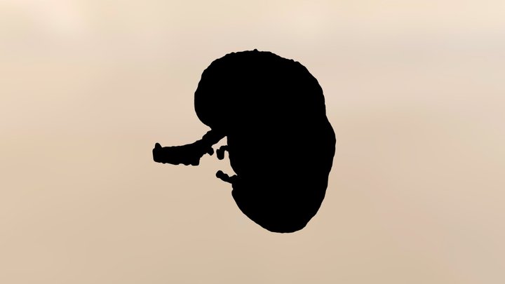 Kidney DM 3D Model