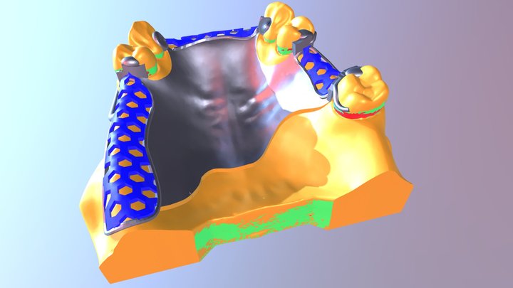 Upper Metal Frame denture 3D Model