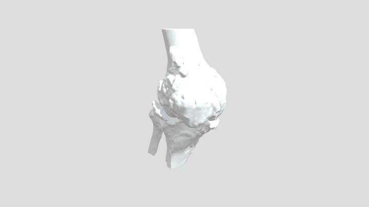 膝关节重度骨性关节炎 3D Model