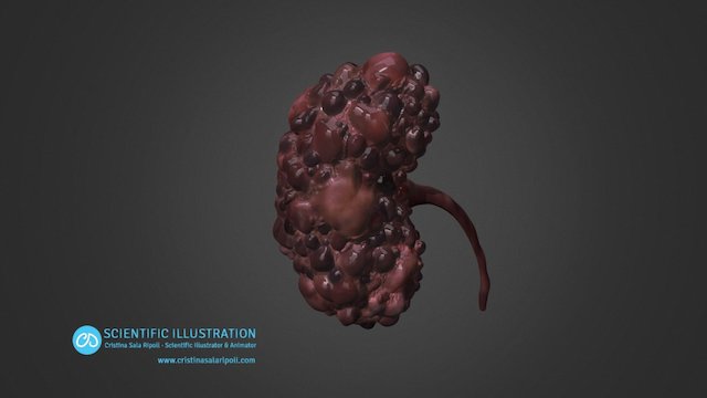 Polycystic Kidney 3D Model