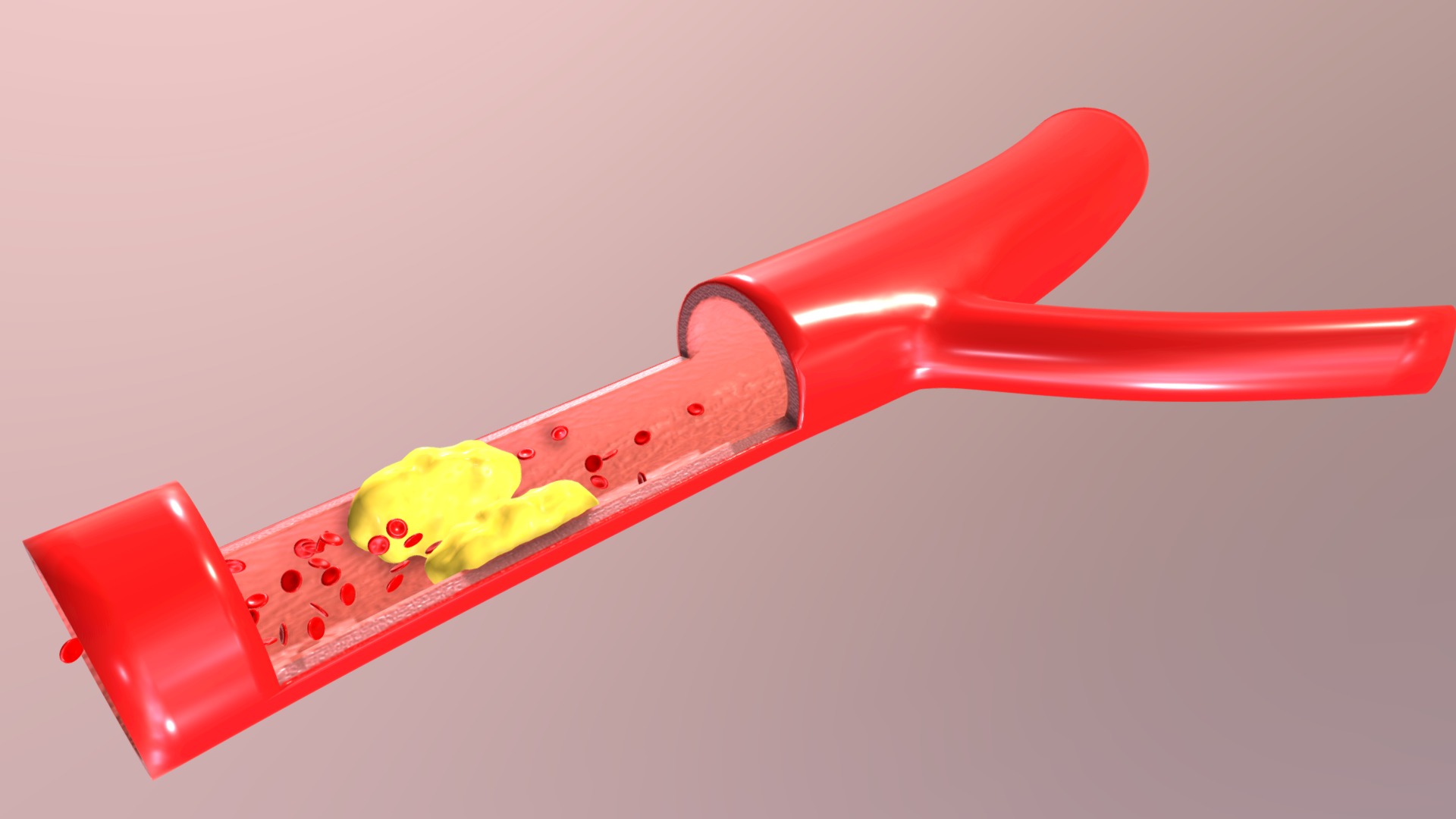 3D model Artery Blockage Detail (animated) - This is a 3D model of the Artery Blockage Detail (animated). The 3D model is about a red plastic toy.