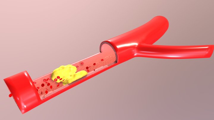 Artery Blockage Detail (animated) 3D Model