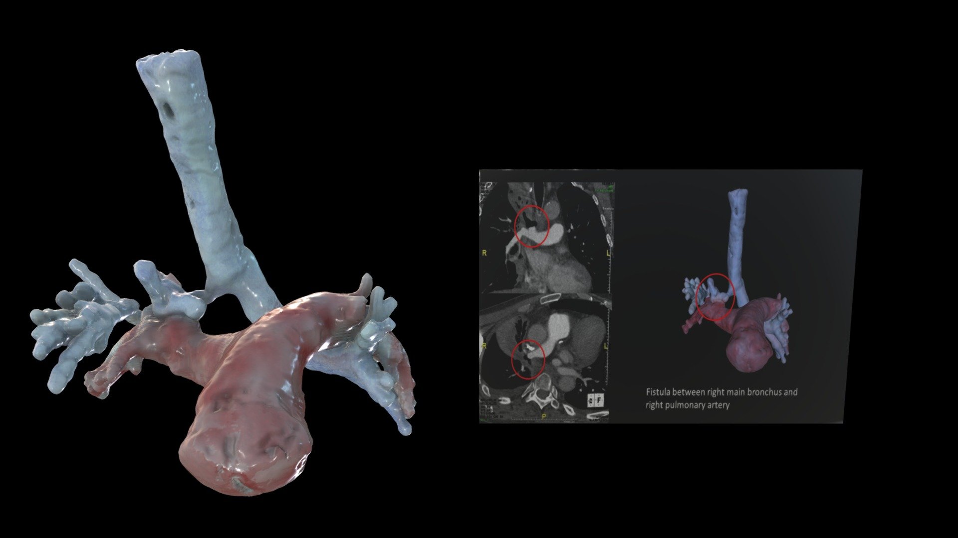 RT Main Bronchus Fistula