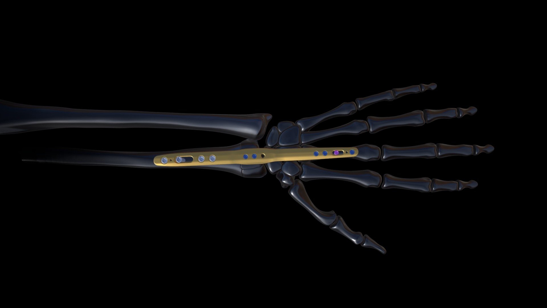 Xpert wrist Spanning plate 3D model by Newclip Technics (Newcliptechnics) [a2b25dc] Sketchfab
