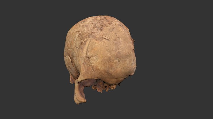 Skull with traumatic injury 3D Model