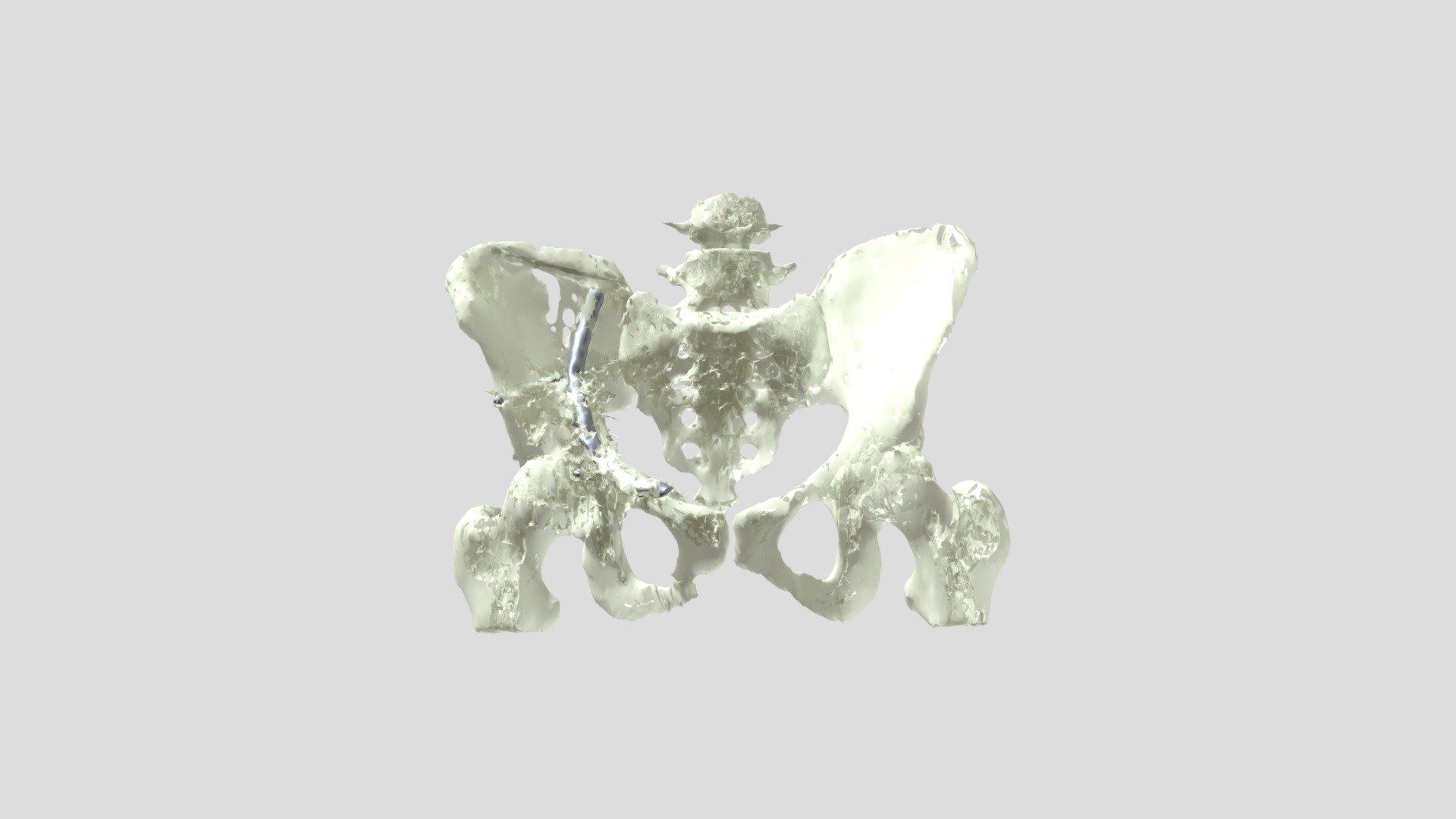 Fracture Pelvis with Hardware