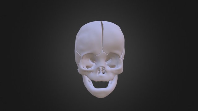 Lambdoid Synostosis Skull 3D Model