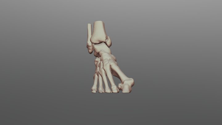Right foot with medial malleolar fracture 3D Model