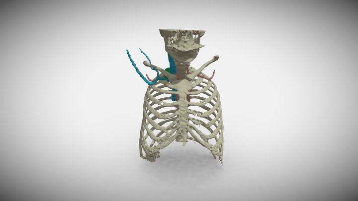 Tumor_1 3D Model