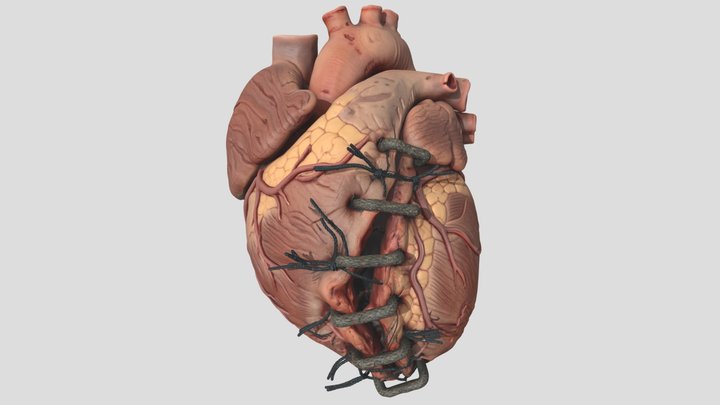 Broken Human Heart
