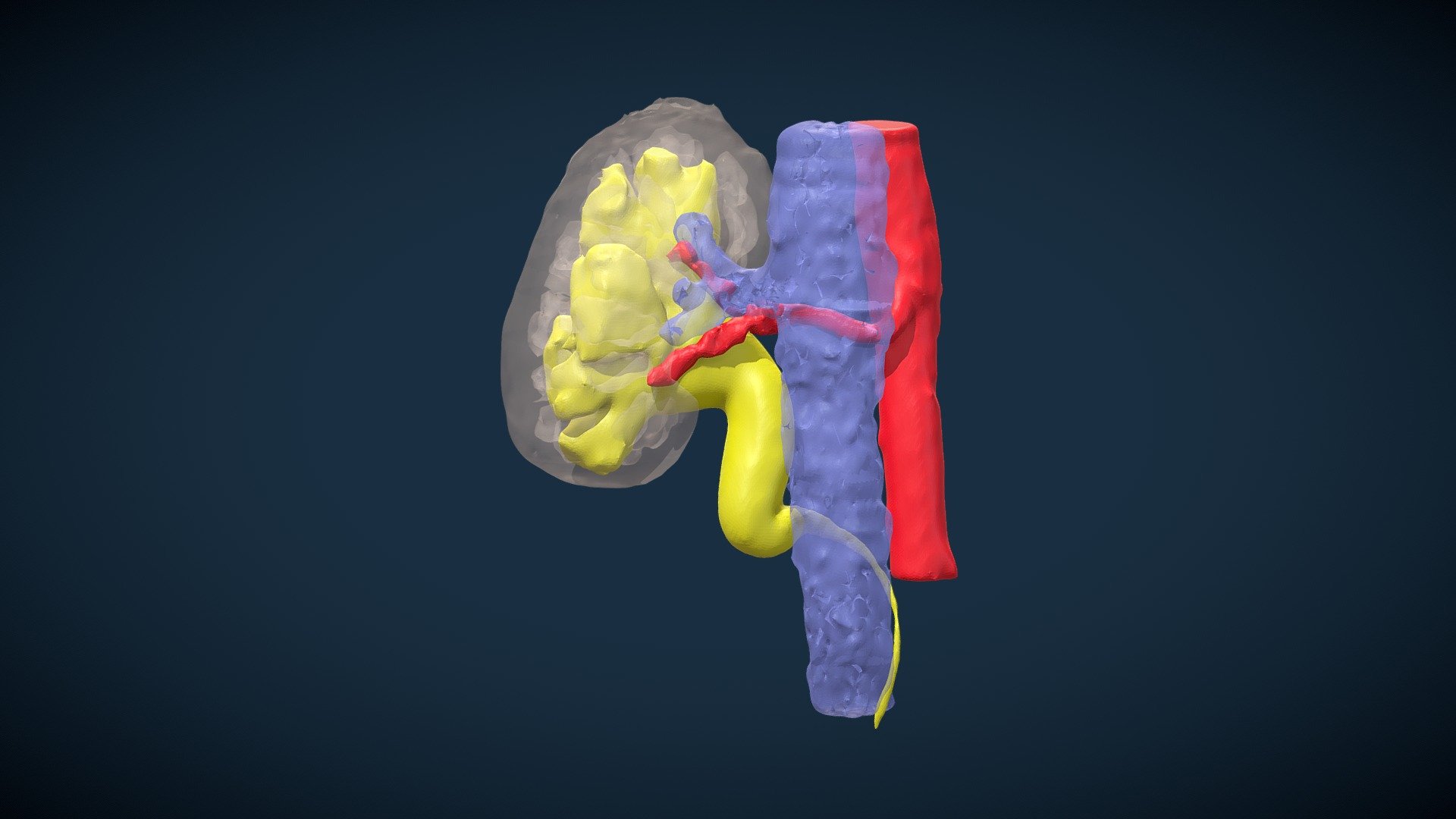 Retrocava Right Ureter (M.C.A.)