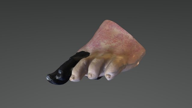 O&P Foot Problem 3D Model