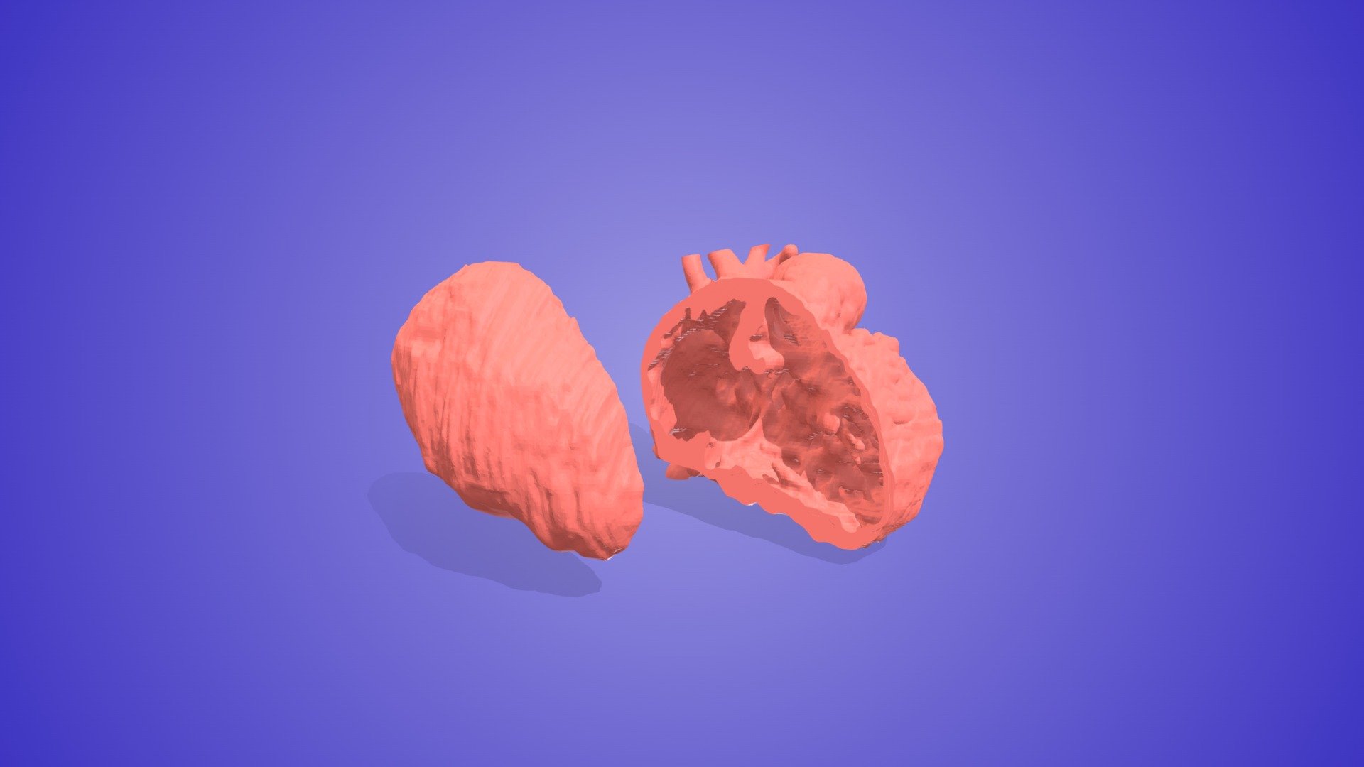 Multiple Ventricular Septal Defects (VSD) - Download Free 3D model by ...