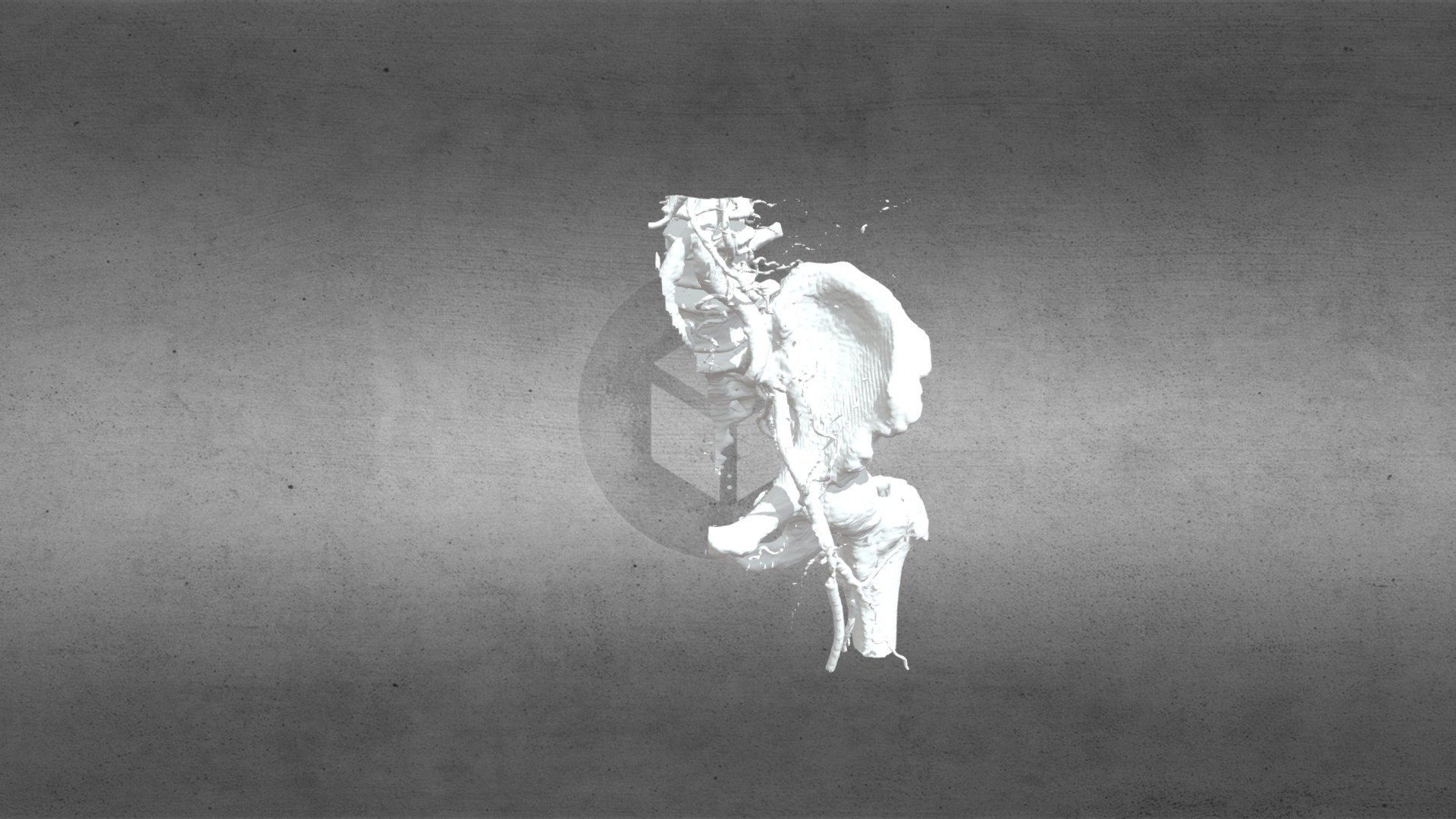 Stenosis arteri femoralis