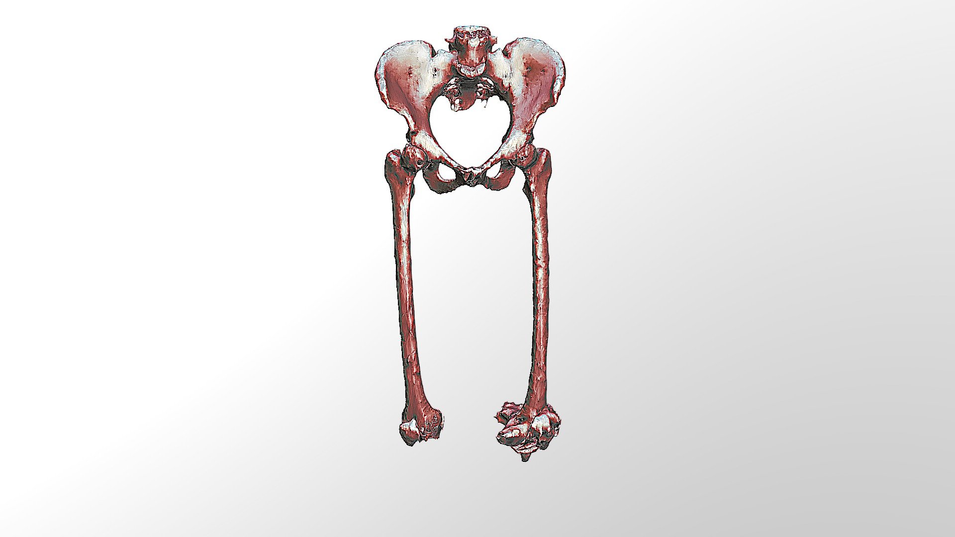 Femur Segmentation Download Free 3d Model By Wohlferta [a414955