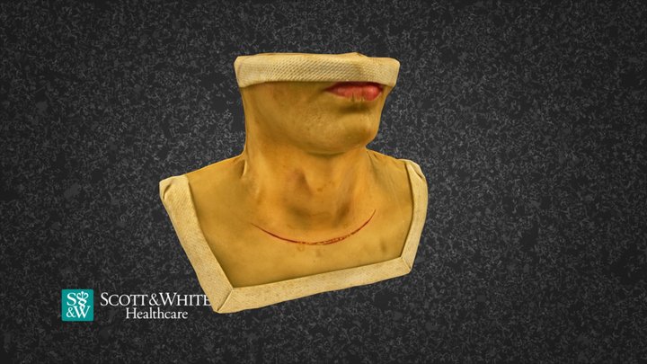 Total Thyroidectomy Surgery - 01 3D Model