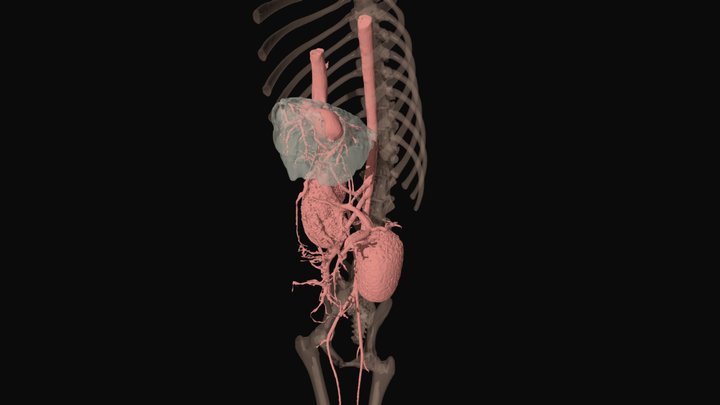 Liver Shunt 3D Model