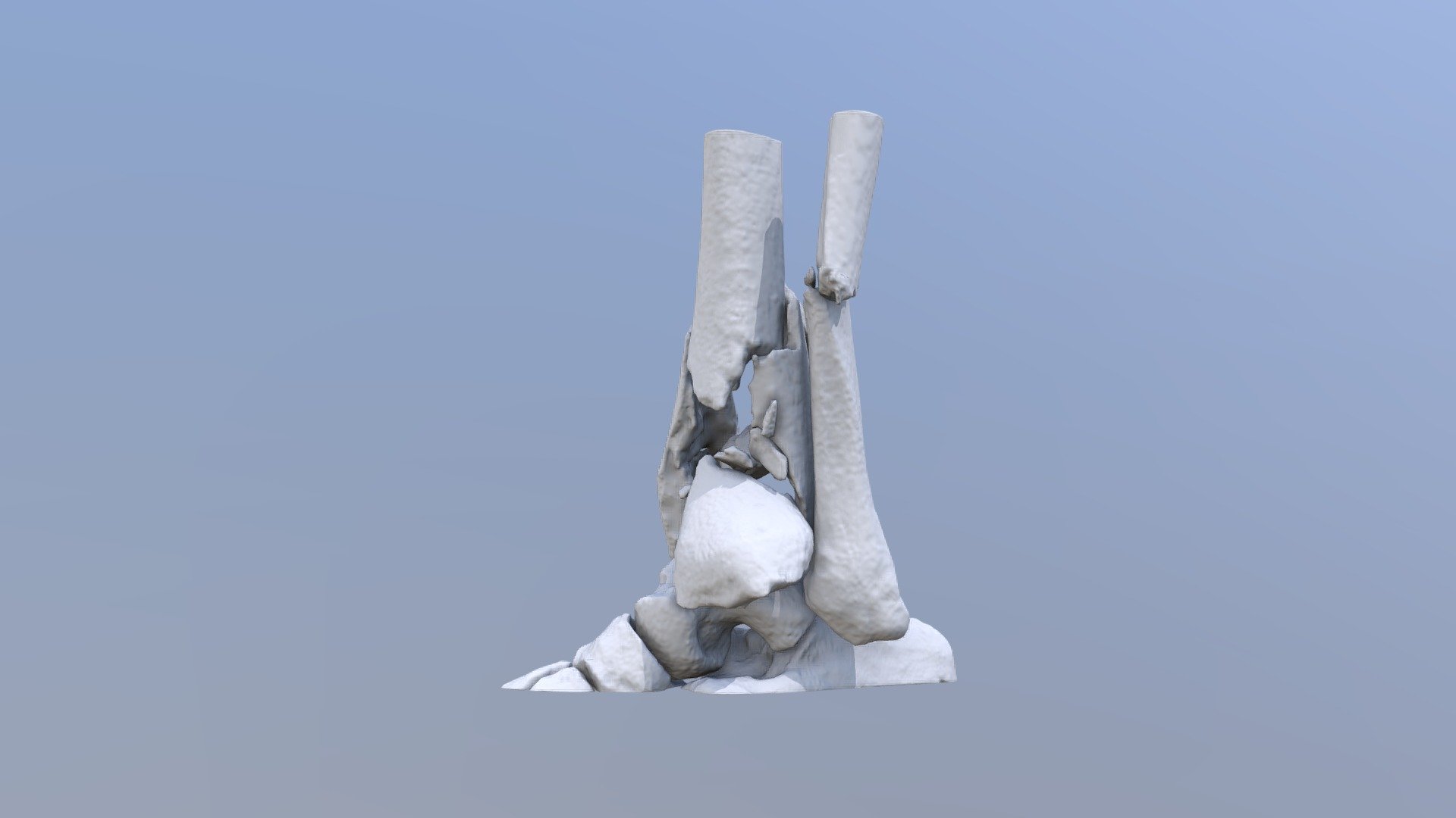 Comminuted fracture of the distal tibia