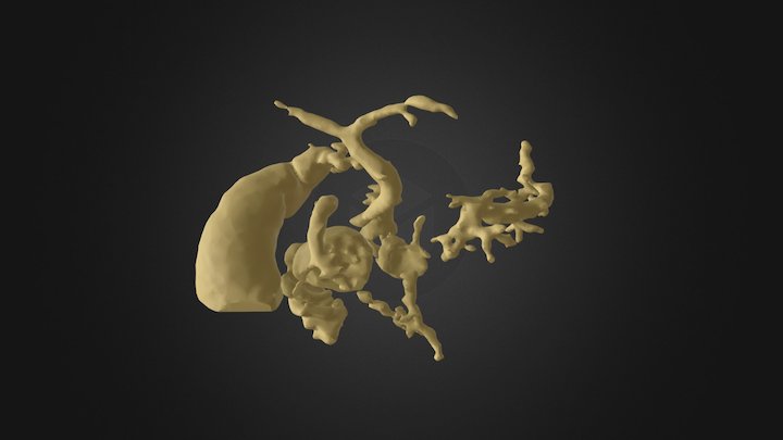 Annular Pancreas with Chronic Pancreatitis '17/8 3D Model