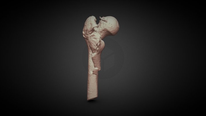 Complex Femural Fracture By CT Scan 3D Model