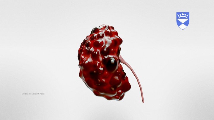 Polycystic Kidney Disease 3D Model
