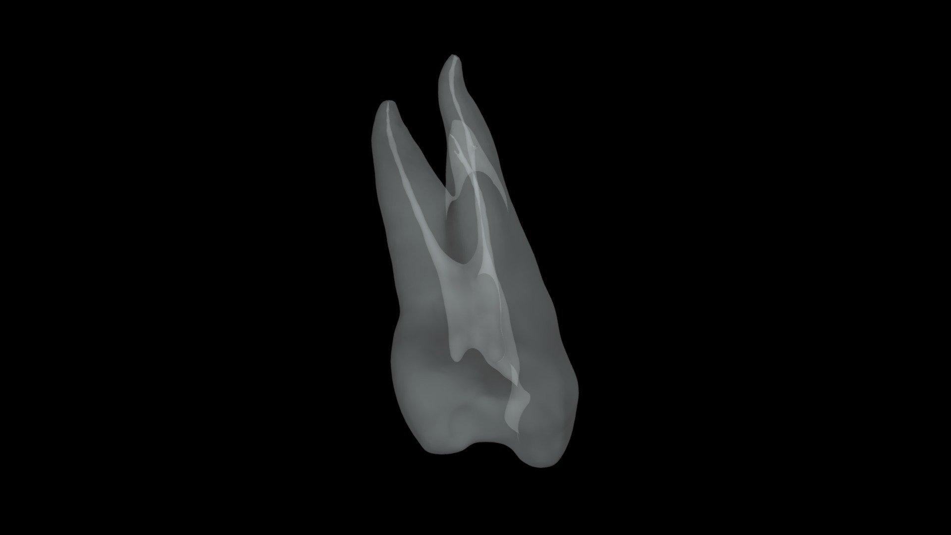 pre molar with carie - 3D model by biomed3d [a6e07be] - Sketchfab