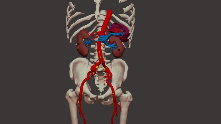 ANEVRYSMES ILIAQUES 3D Model