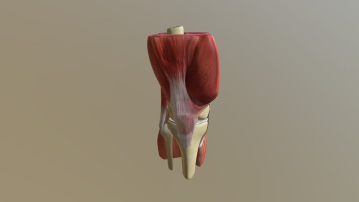 ACL Tear 3D Model