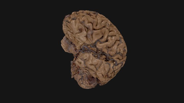 Middle Cerebral Artery and branches 3D Model