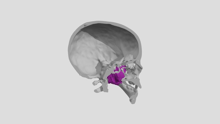 Osteosarcoma of the Jaw (S0261) 3D Model