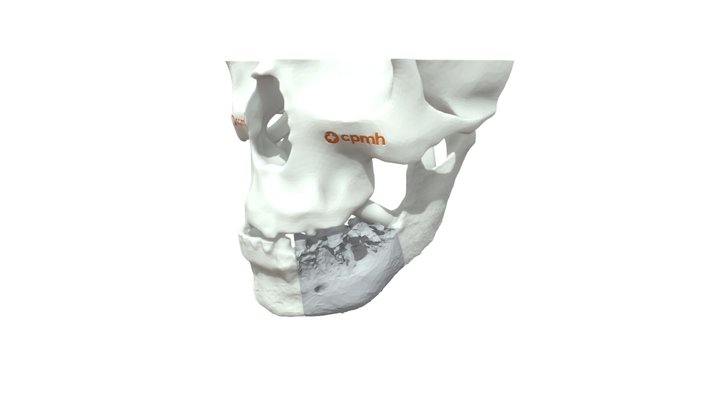 Pedido 5530/5531 - Reconstrução Mandibular 3D Model