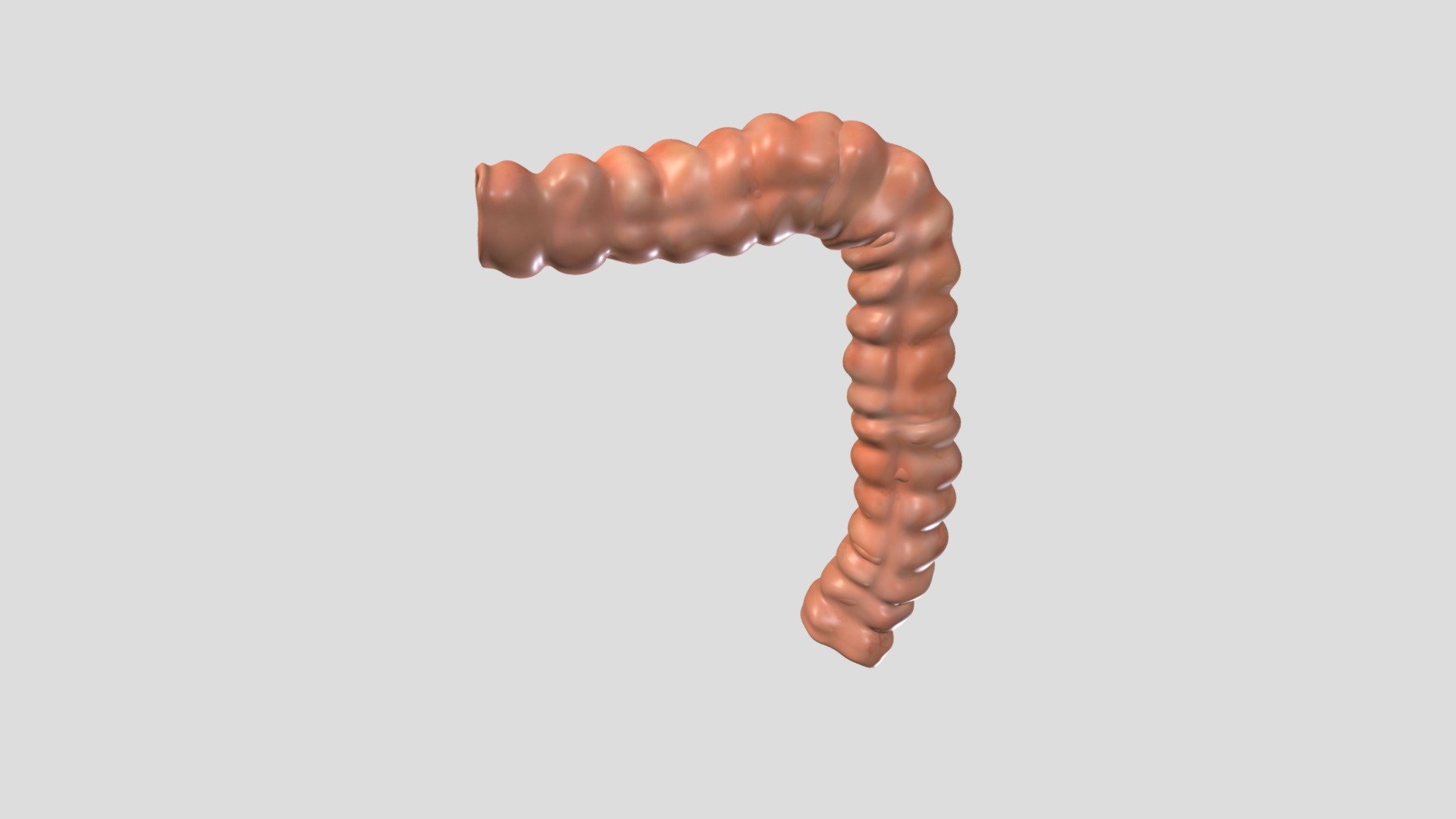 Xanthomatous Polyp Colon