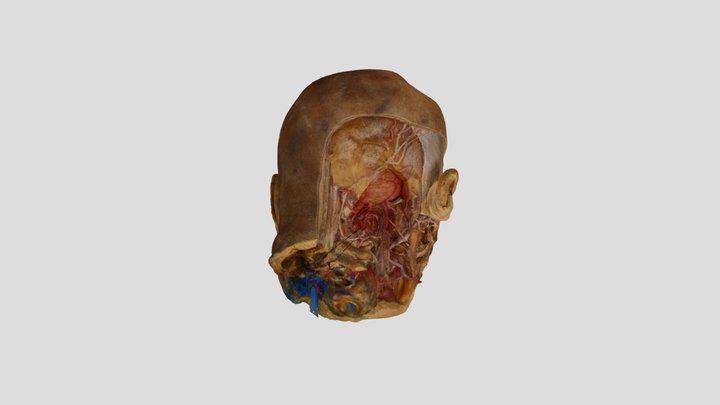 9- Suboccipital Craniectomy + C1 Resection+OCLQ 3D Model