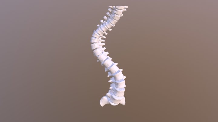 脊椎側彎模型wrap 3D Model