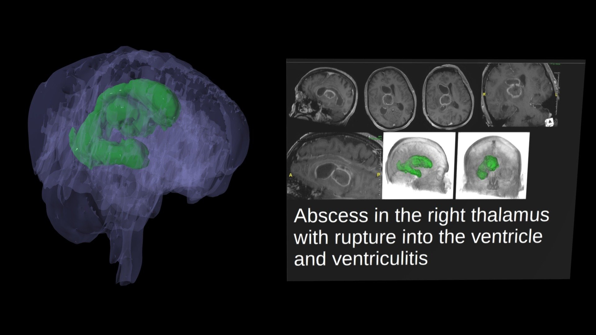 Rt Brain Abscess and Ventriculitis - 3D model by tl0615 [a9927c5 ...