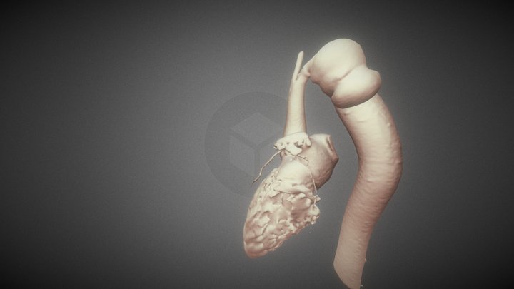 Aneurysm after repair of aortic coarctation. 3D Model