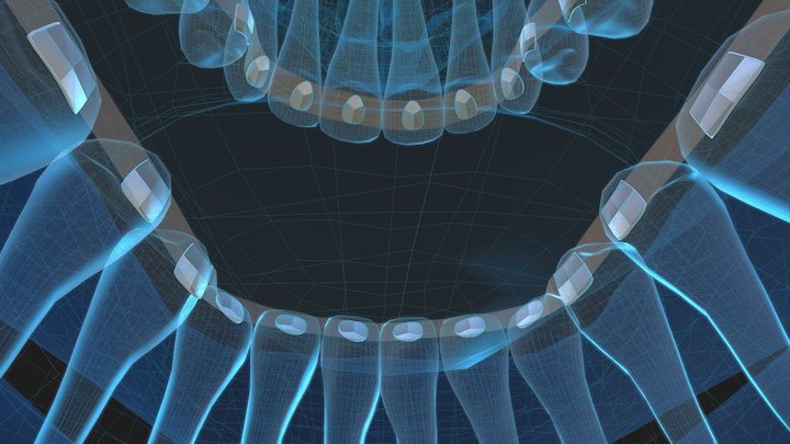 Lingual Orthodontics AEZ 3D Model