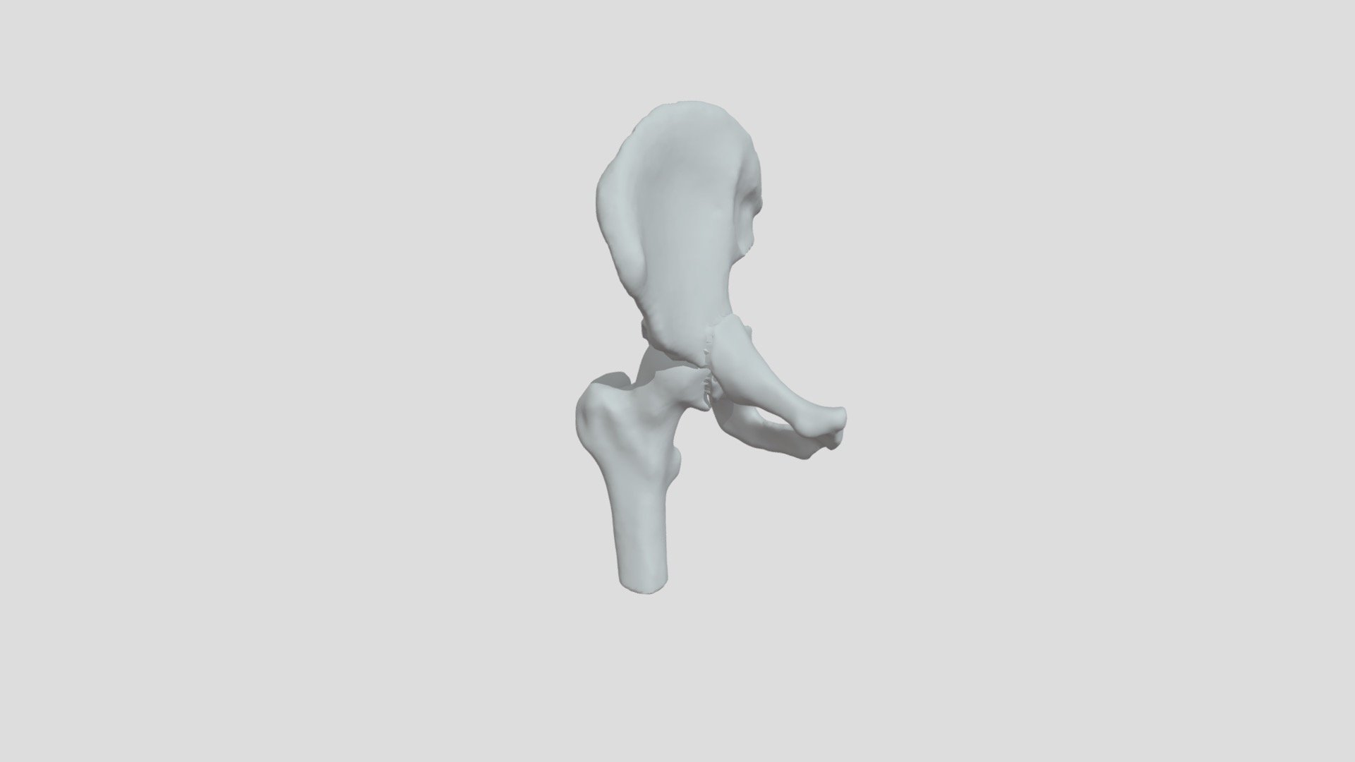 Pipkin IV fracture, posterior acetabular wall - 3D model by Trizlov ...