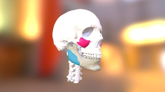 Jaw Surgery + Facial Implants (Finish) 3D Model