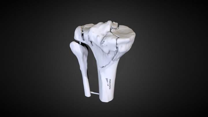 DKOU2018 | Tibial Head Fracture | #I-180074-L 3D Model