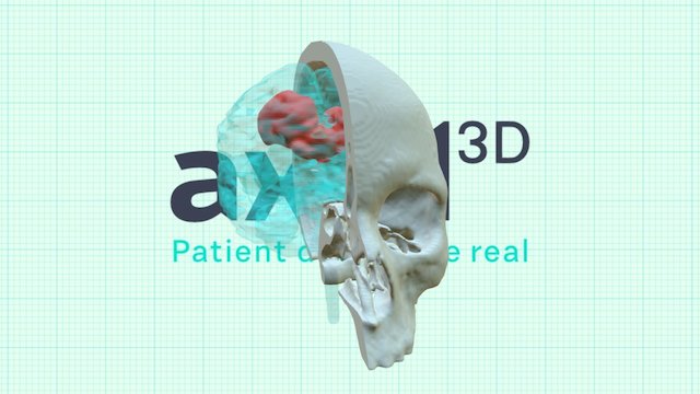 Skull, Brain And Tumour 3D Model