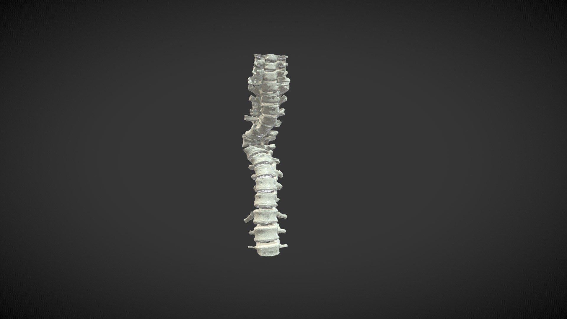 scoliosis 3D model by Lincoln Wong (lincolnwong) [abe68db] Sketchfab