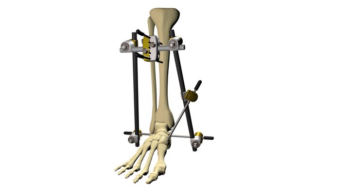 OIC Large External Fixation System 3D Model